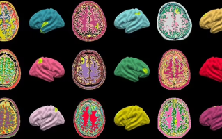 AI 算法能检测大脑缺陷，有助于治疗癫痫疾病