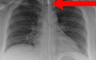 女子呼吸困难紧急就医 X光发现体内有1米长iPhone数据线