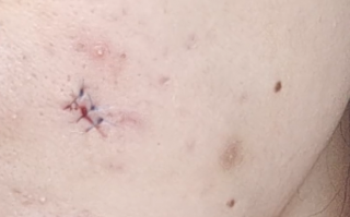 女子挤痘痘脸部感染手术缝6针：表皮样囊肿、缝了2层