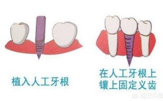 种植牙的优点与缺点是什么（种牙外提升优缺点）