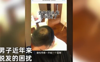 男子秃顶半月不用洗发水后长出头发：网友神评论