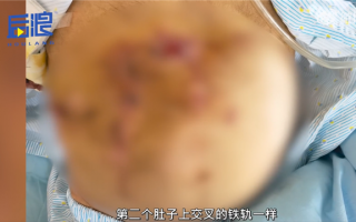 35岁男子饮酒过度2年开腹8次 肚皮如铁轨交叉