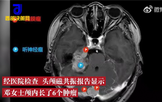 女子信土方补体虚 3年脑内长6个瘤 医生：类似情况需及时就医