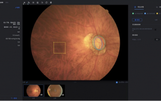 AI 辅助判断青光眼，腾讯成国内首个获批创新医疗器械的互联网科技公司